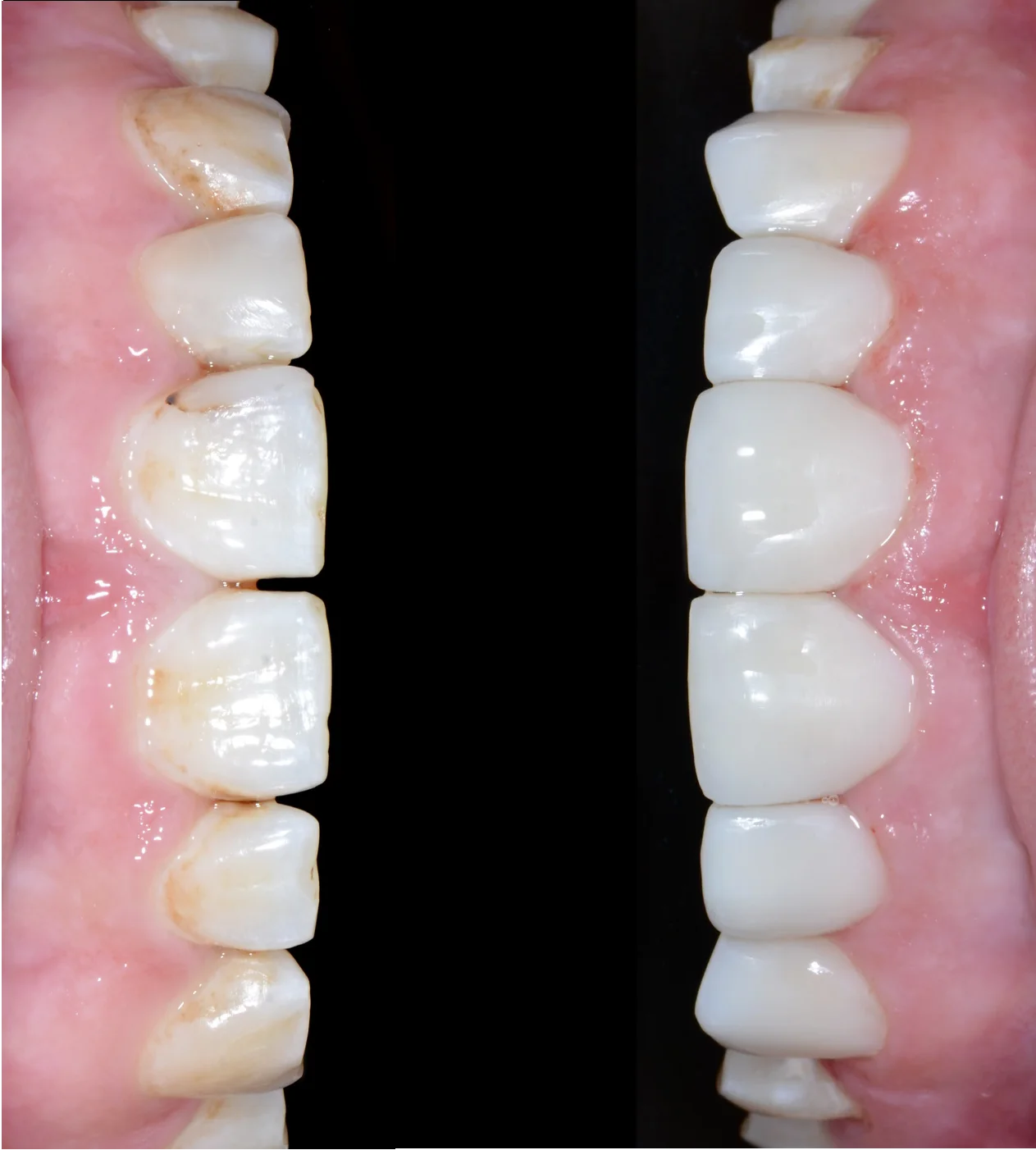 Художня Реставрація зубів