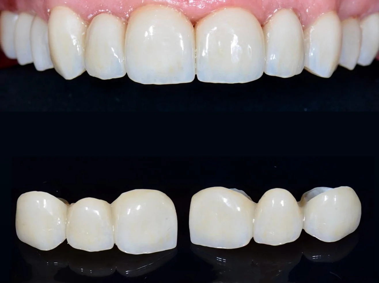 Відновлення функції жування після втрати зубів