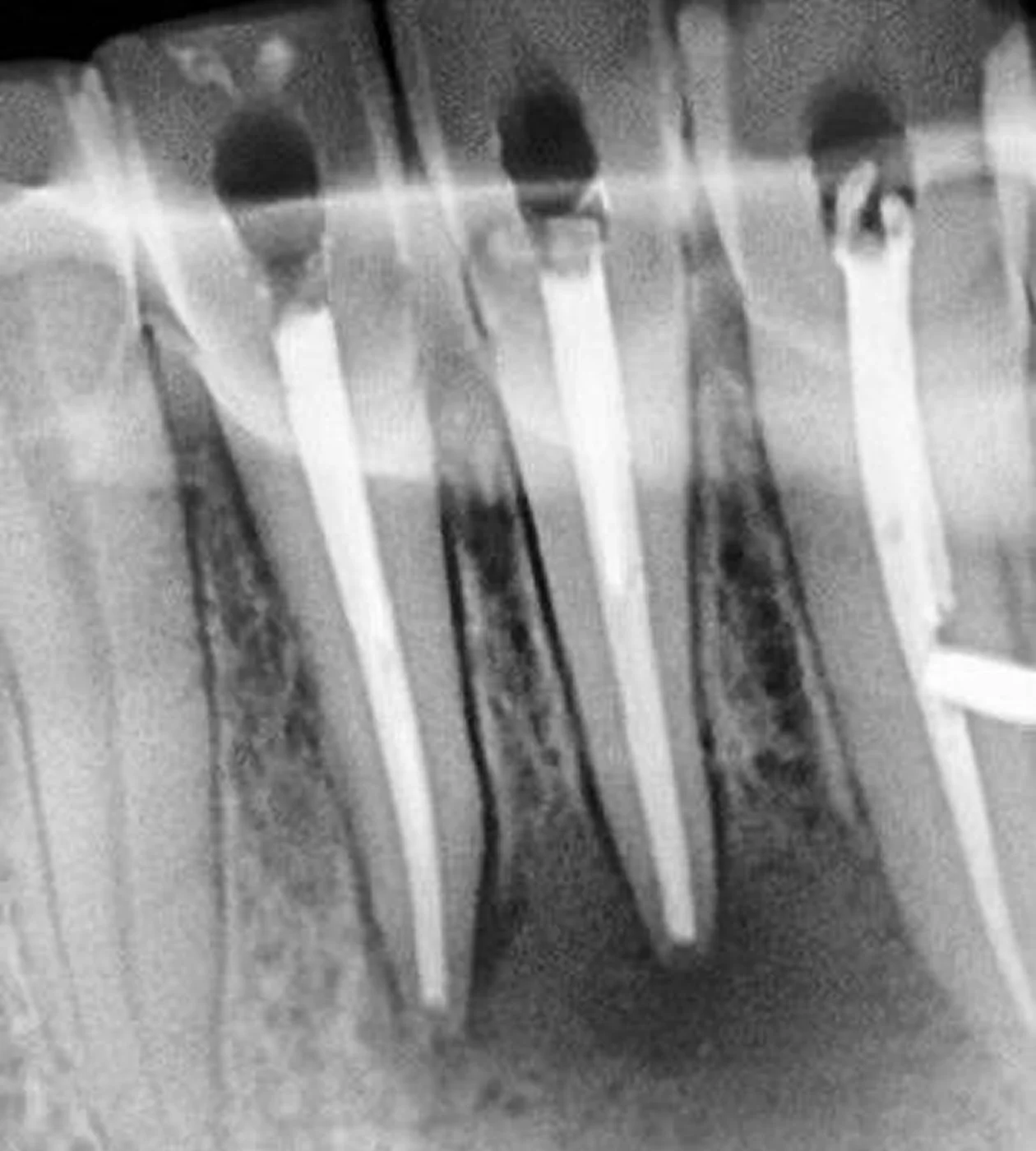 Ендодонтія (лікування кореневих каналів)