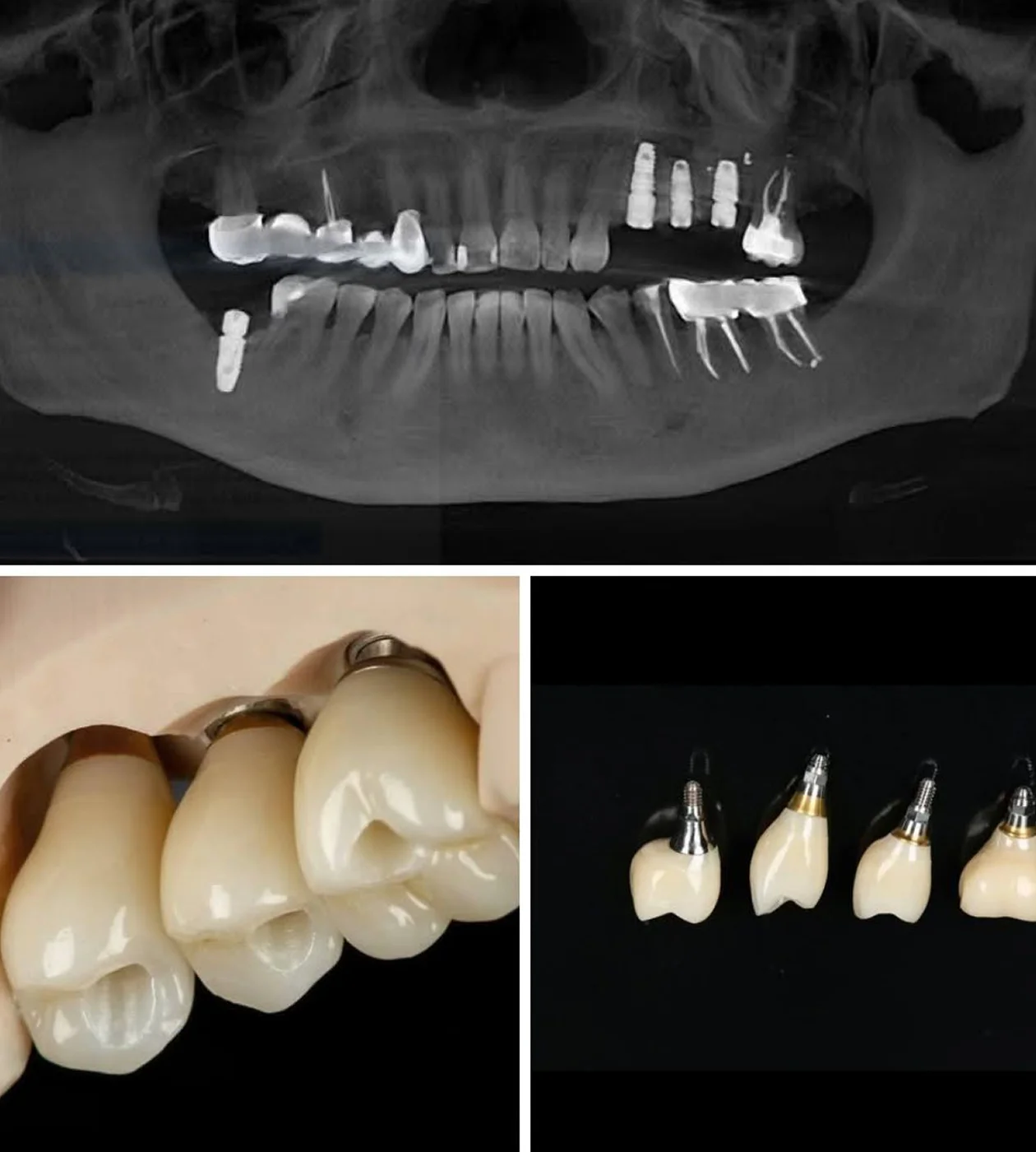 ПРОТЕЗУВАННЯ НА ІМПЛАНТАХ