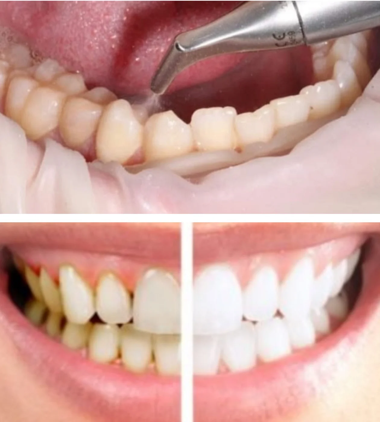 Професійна гігієна по протоколу SRP