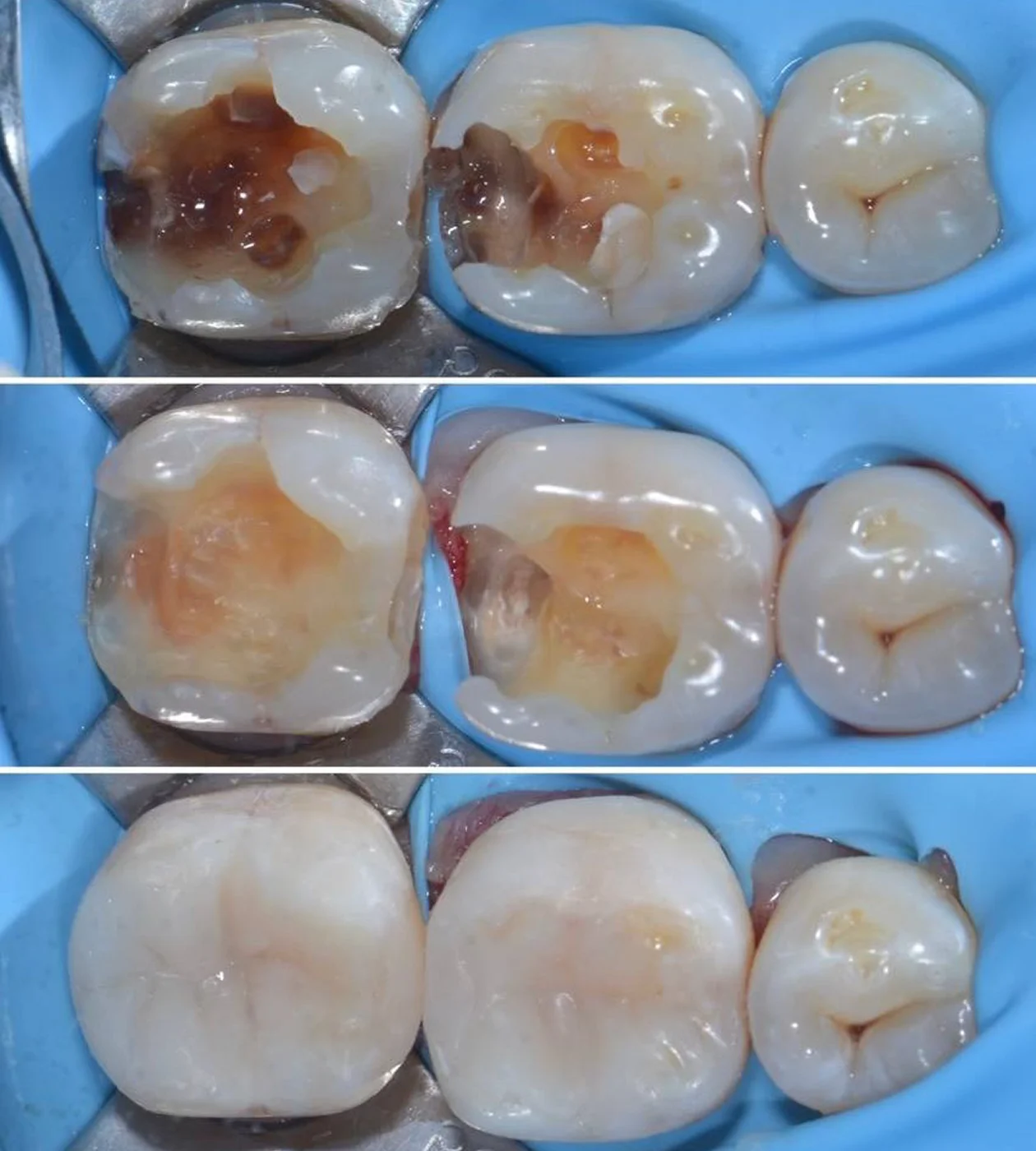Лікування каріозних уражень зубів
