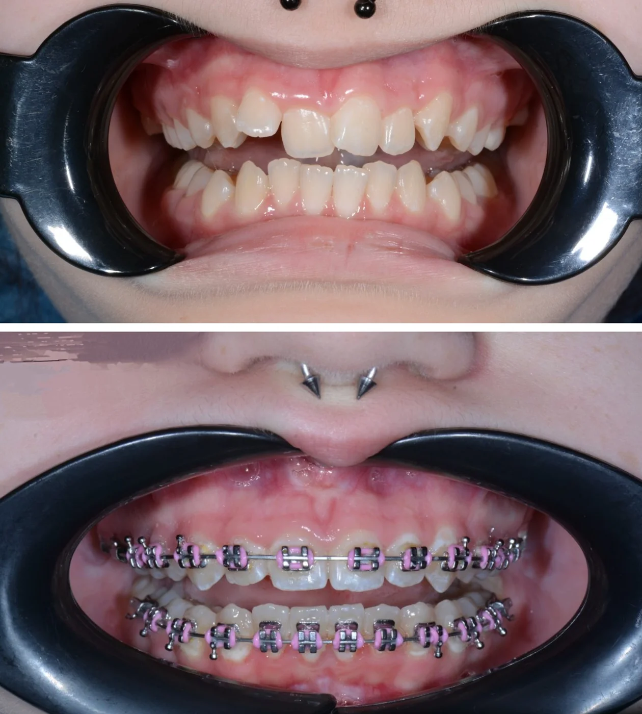 Лікування патологій прикусу