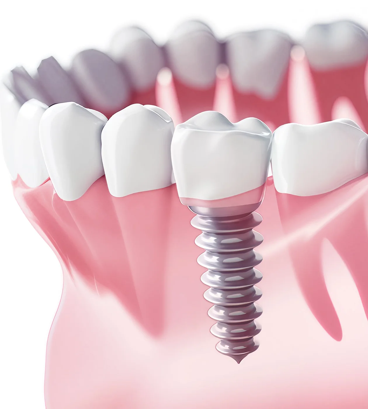 Дентальна імплантація